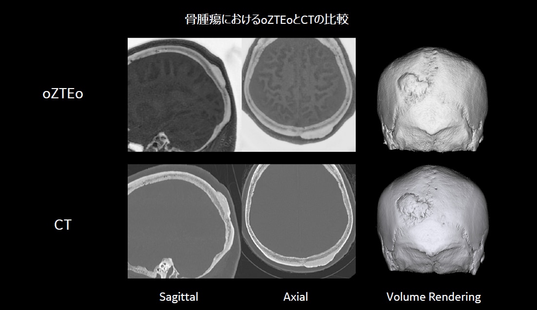 脳神経外科領域におけるMR Bone imaging : oZTEoの活用法 | GE